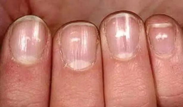 从指甲就能看出肺癌是真的但没那么简单