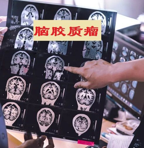 中医治疗胶质瘤方法,脑胶质瘤使用中医治疗还是很好的,最好是使用中西