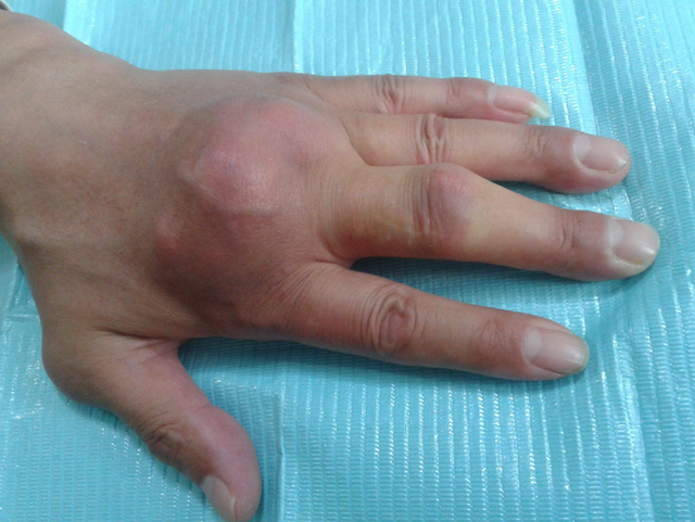 这种一般就是痛风石,是体内尿酸过多导致结晶沉淀而形成的,常见于脚趾