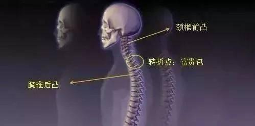 指的是在后背上部颈胸交界处(即在第七颈椎和第一胸椎处)凸出的硬包块