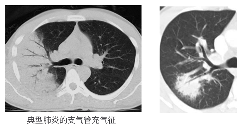 6 空气支气管征:细条状,直径约 1 mm 的空气密度影