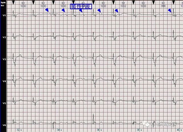 心电图病例分析34:心室起搏心律vvi模式