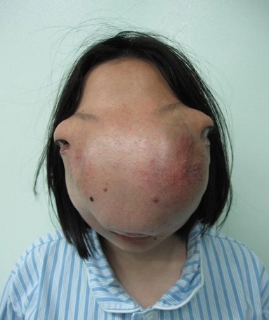 真实故事浙江22岁少女患怪病人身马面蒙面13年如今重获新生