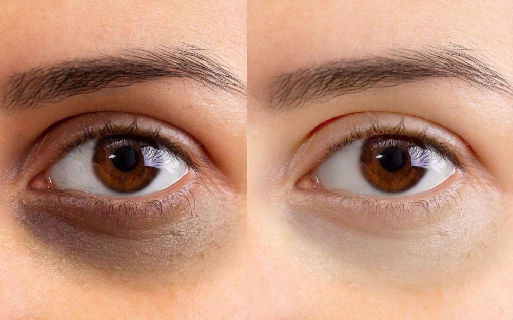 黑眼圈位于下眼睑皮肤层,包括脂肪,血管,黑色素细胞等