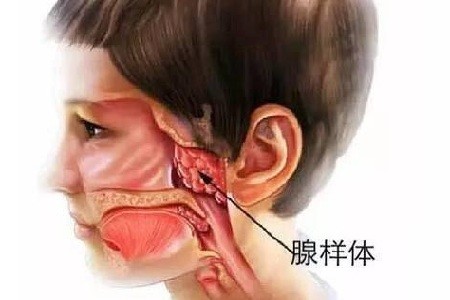 宝宝腺样体肥大有什么症状