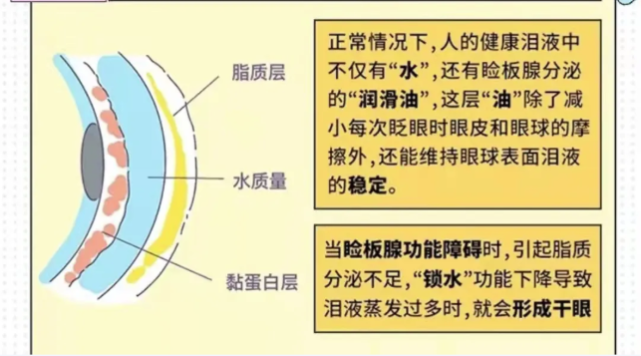 兰州爱尔实用科普 | 干眼九问九答，你想知道的都有！(图2)