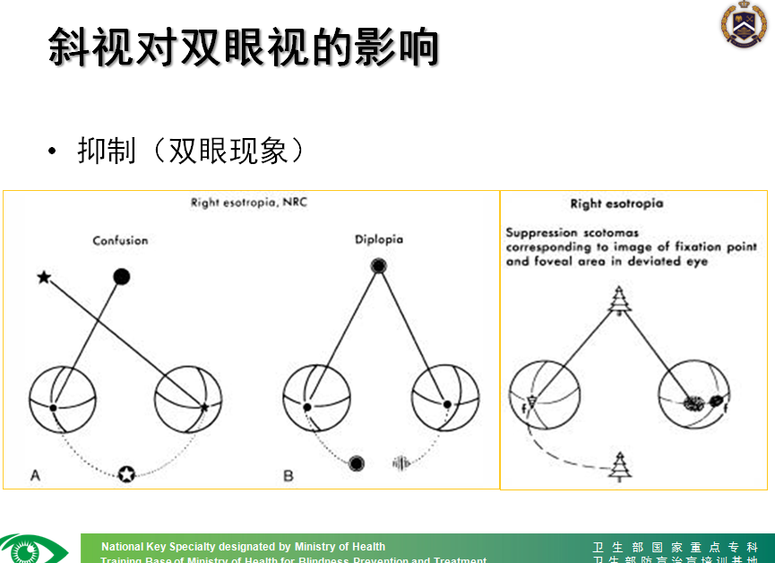 经典ppt课件斜视引起的双眼视觉异常