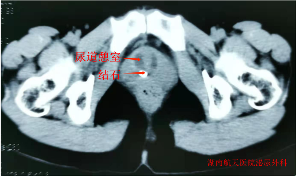 原来尿道憩室是长这样的,听说过尿道憩室也可长结石吗?