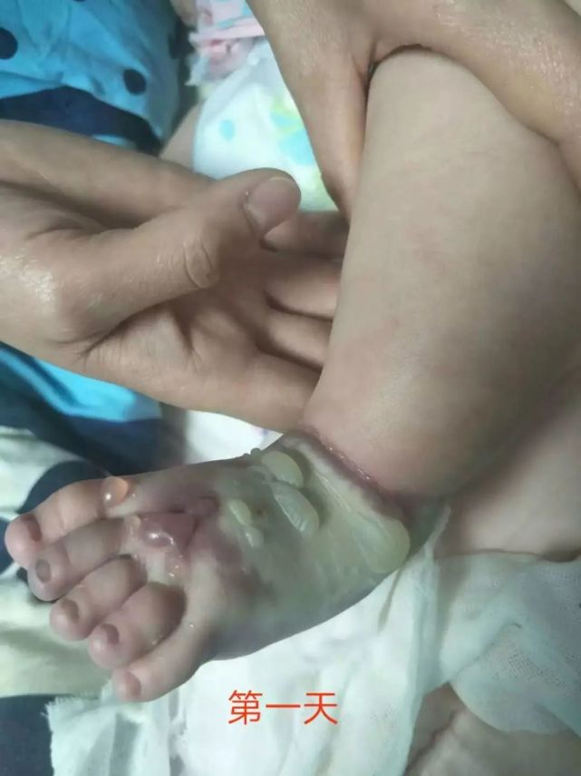 触目惊心一例患儿输液渗漏的案例讨论