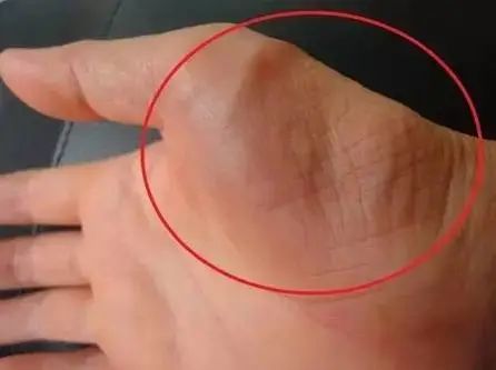 温州东华医院科普腕管综合症