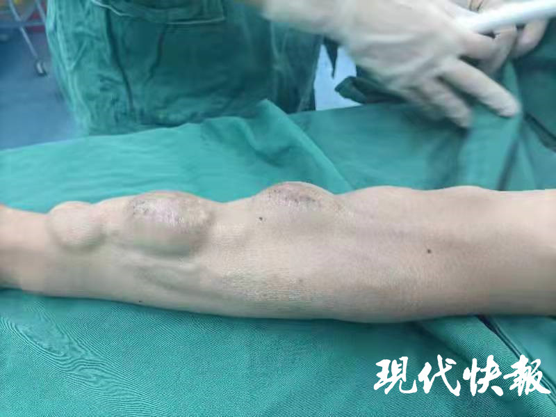 尿毒症患者手臂鼓起3个血管瘤医生5小时拆弹