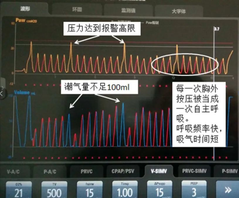 呼吸机5种模式不会选择看完这篇你就懂了