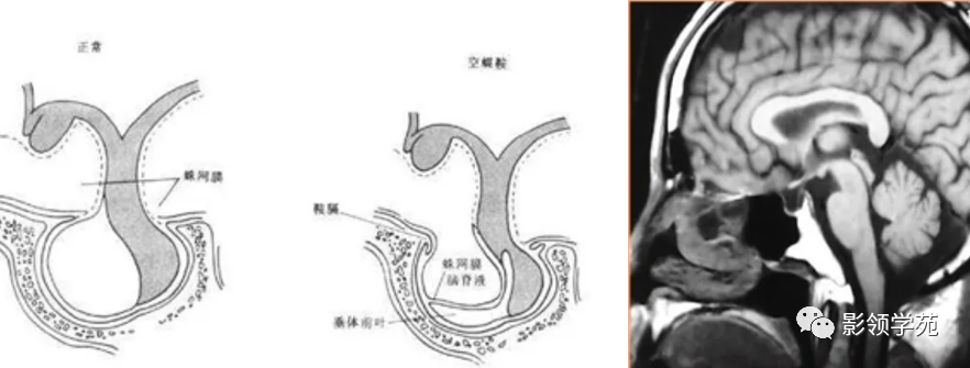 垂體解剖及常見病變影像學表現