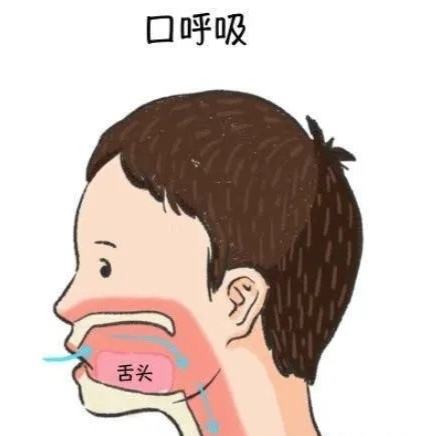 尚牙圈口呼吸会让人变丑是真的吗