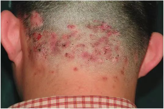 头皮毛囊炎是指仅累及头部毛囊及其周围组织的细菌感染性皮肤病.