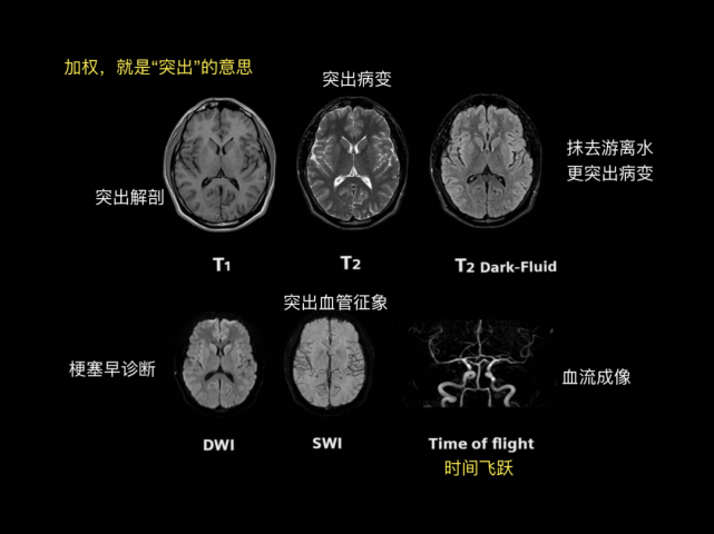 t 徵,Ω 徵額下回,顳橫回,broca 區,wernicke 區腦葉,基底節區海馬