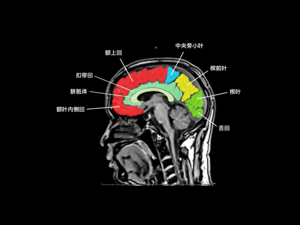 颅脑 mri 矢状位垂体瘤颅脑 mri颅脑 mrv鞍上池,脚间池,环池,四叠体池