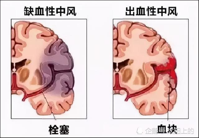 大脑供血不足腿先知