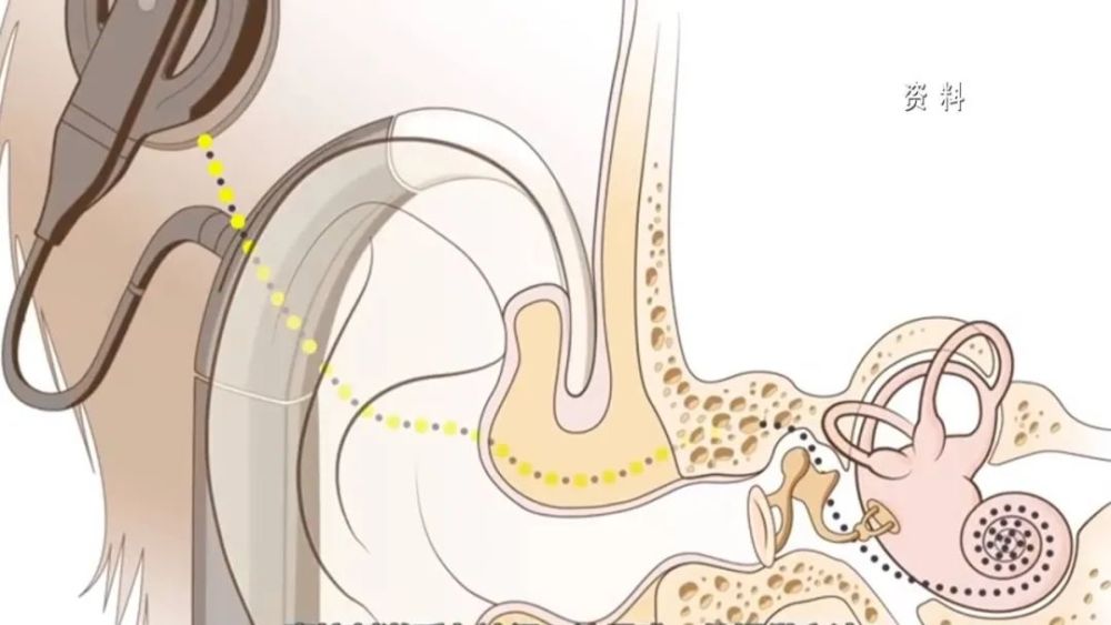 人工耳蜗植入体图片