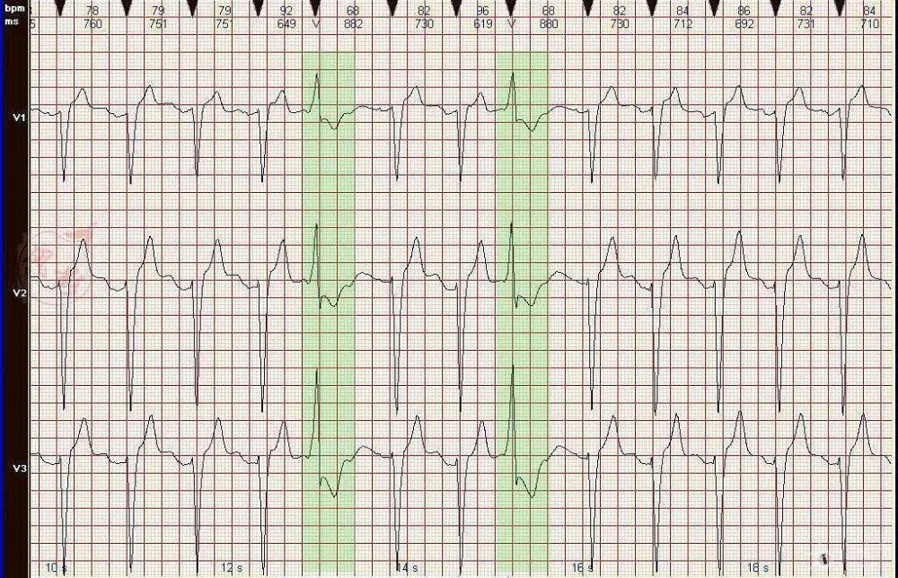 心电图病例分析37完全性左束支阻滞室性早搏