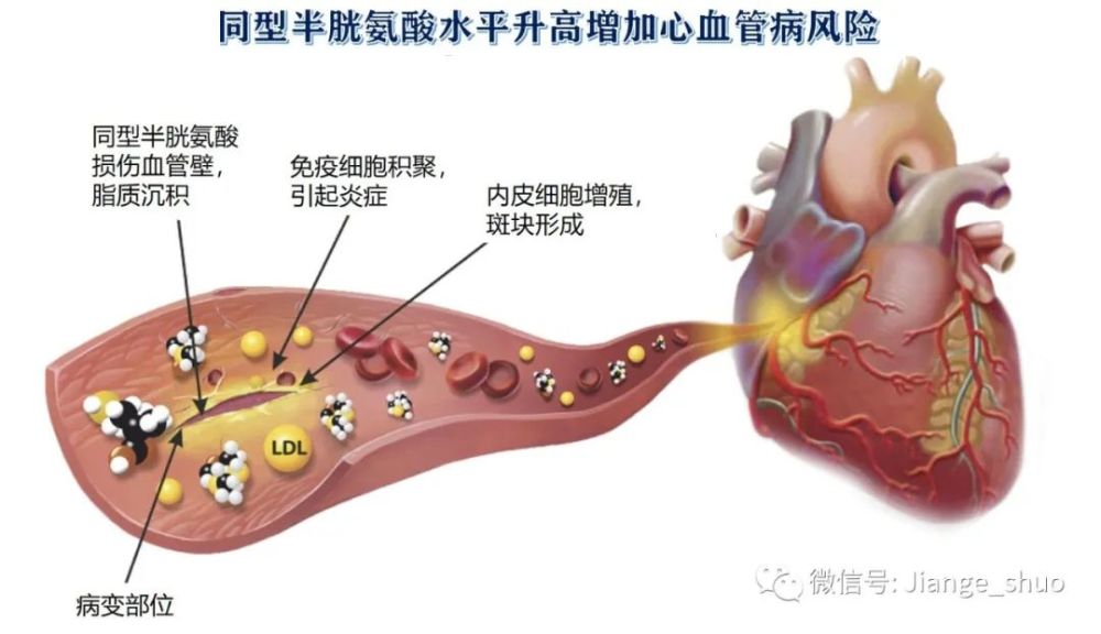 健哥說心臟有聲版|高血壓加個