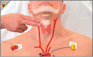 颈动脉窦|颈动脉窦综合征