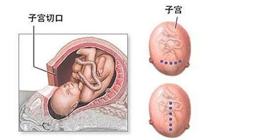 孕妇在手术过程中,医生选择做纵切口,这种竖切口一直延伸到子宫上段