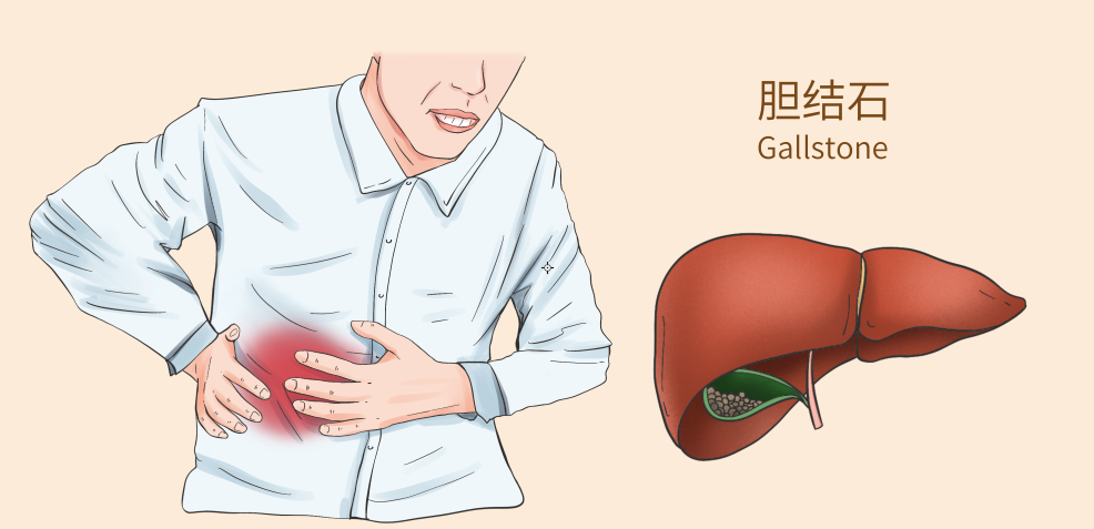 我们把这种情况称为"无症状胆囊结石"