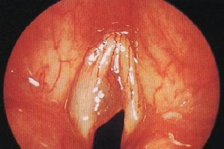 咽喉后壁息肉图片图片