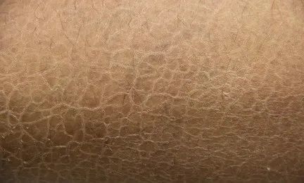 鱼鳞病除了影响外观,还有这些并发症的危害!_腾讯新闻