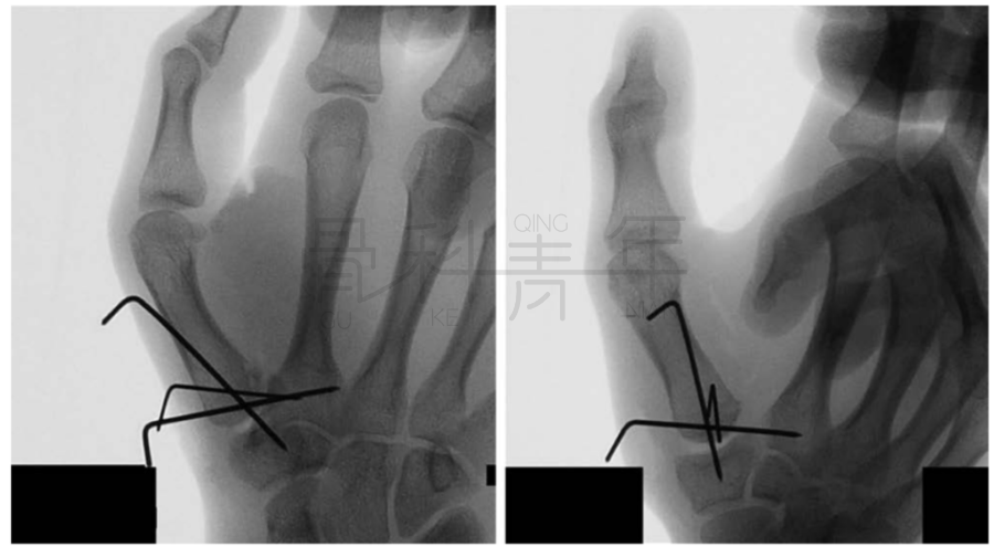 對拇指基底部骨折(bennett或rolando骨折),可先軸向牽引後置入一枚克