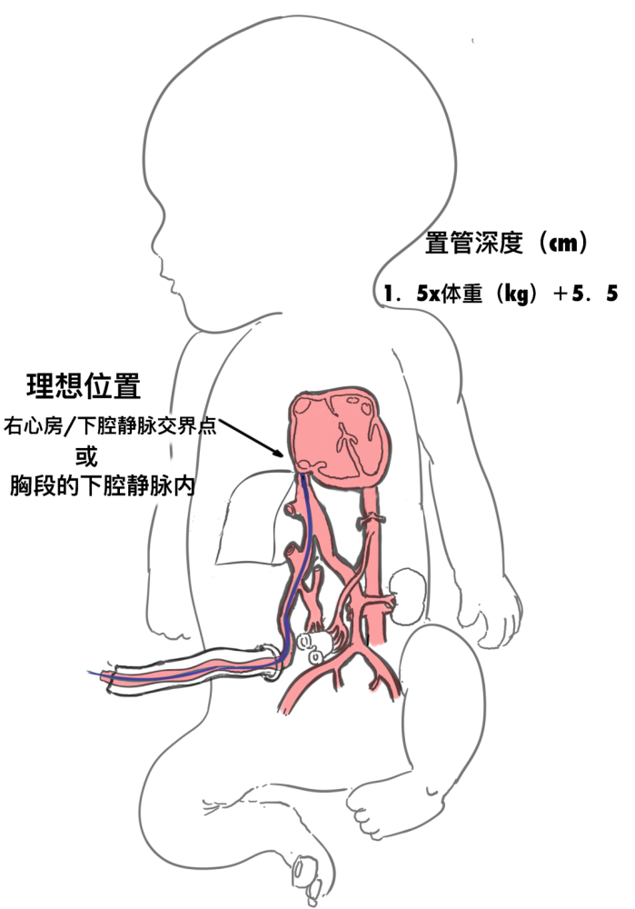 早產兒成長記臍靜脈置管