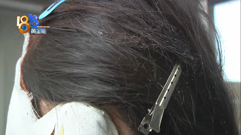 头发也残有烧焦的痕迹.