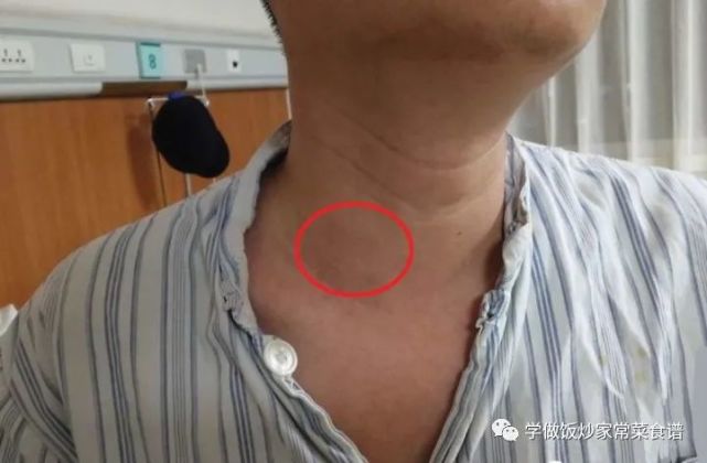 1天1个鸡蛋快递小哥查出甲状腺癌医生无知吃一口等于8斤塑料袋