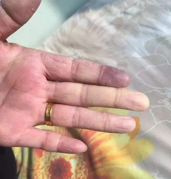 冰冷的病房她伸出青一块紫一块的手医生告诉她这是一种病