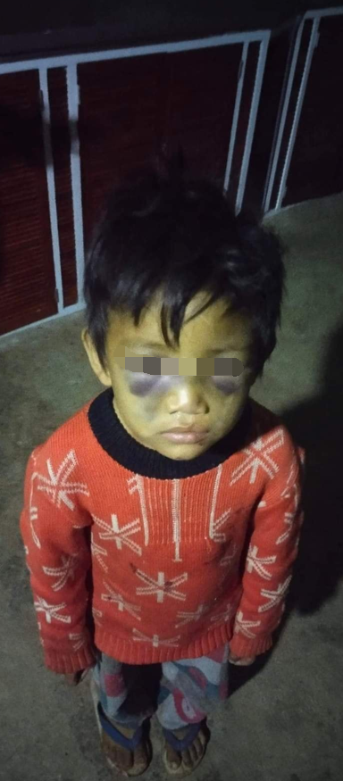 看着心痛缅甸腊戌一年幼孩子被酗酒母亲家暴被打得鼻青脸肿