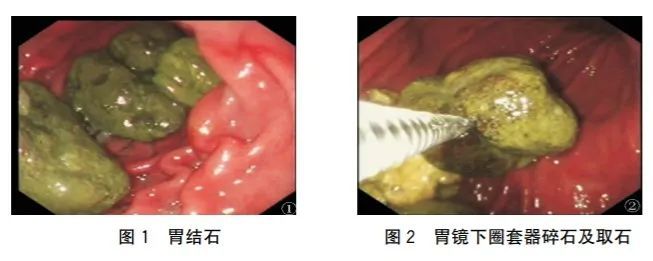 图片来源:参考文献[4]而胃结石的症状除了肚子胀痛,还可能导致恶心