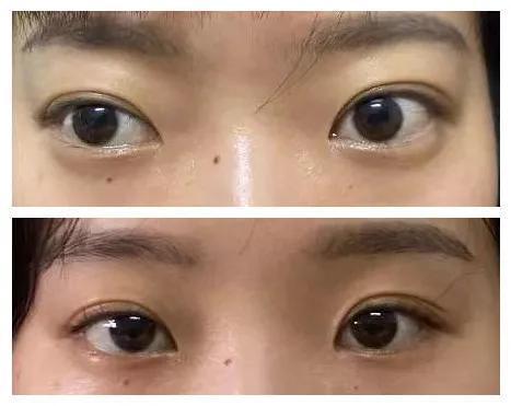 加班熬夜生闷气22岁女生眼肿成金鱼眼