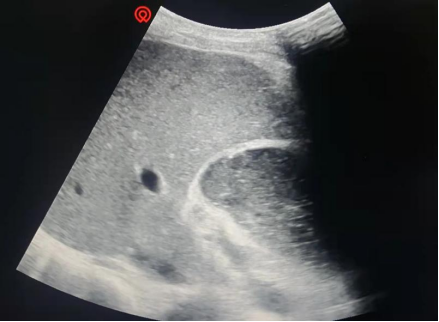 抽查的部分淤积胆汁哈医大四院松北超声科开展超声引导介入诊疗项目:1