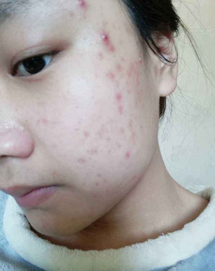 在夏天长痘的人比较多为什么冬天还有不少人长痘呢洛阳肤康