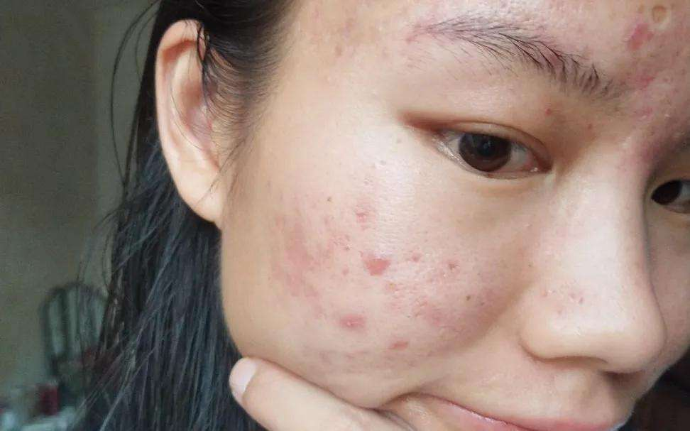 在夏天长痘的人比较多为什么冬天还有不少人长痘呢洛阳肤康