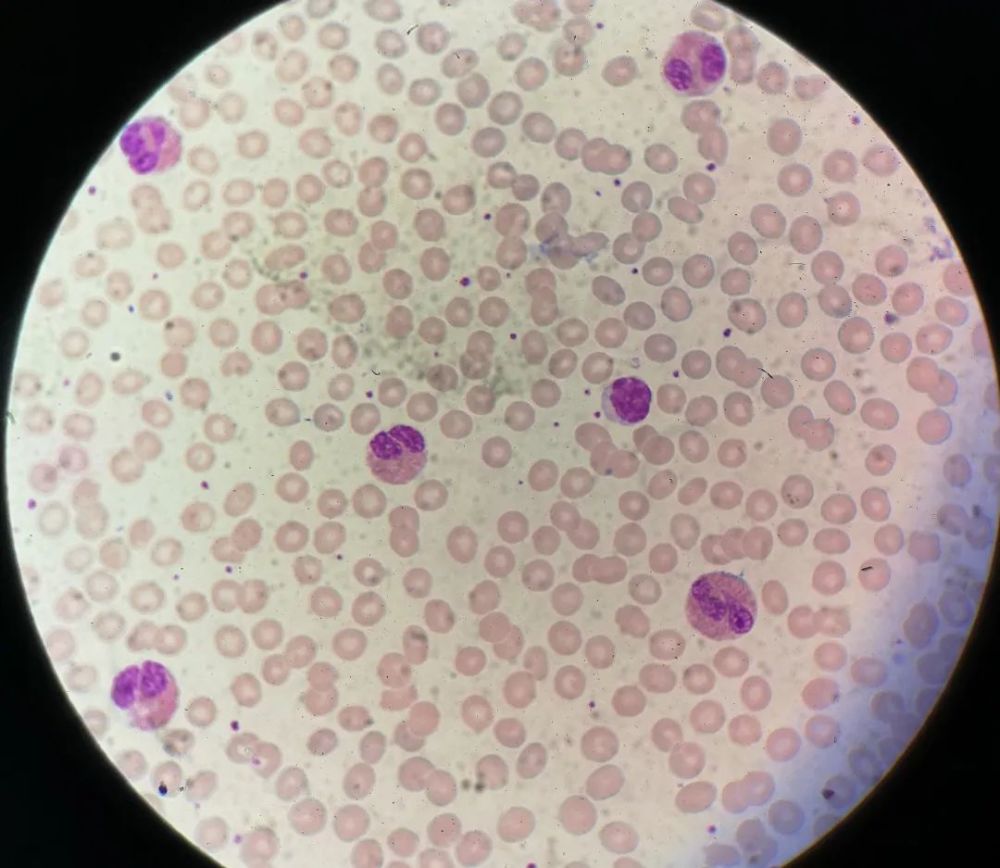 图1血涂片瑞姬染色镜下可见许多典型的嗜酸性粒细胞,手工计数比例和