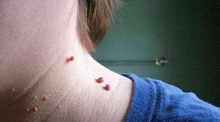 肉粒"在初期形成时通常呈丘疹或小红点状,后期会发展成鸡冠状或菜花状