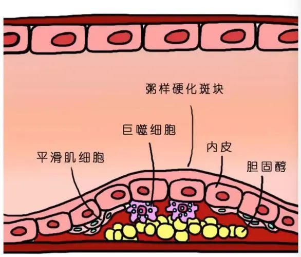 脂蛋白a高是怎麼回事