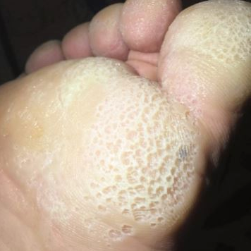 是窝状角质松解症,也叫沟状跖部角质松解症,是一种出现在跖部角质层的