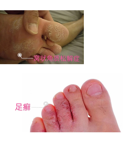 长期穿靴子注意了脚底板会长这种小洞洞