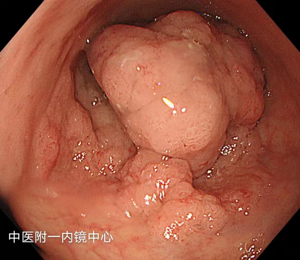 古稀老人肠道内现巴掌大肿物,医生巧手解除警报