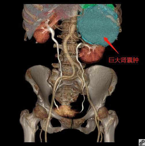 深圳七旬阿婆忍痛半年后查出巨大肾囊肿_腾讯新闻