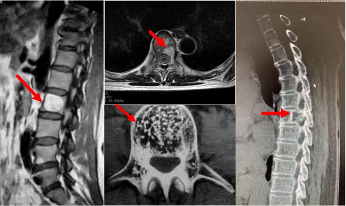 腰椎里长了肿瘤!先别慌,其实椎体血管瘤并不可怕_腾讯新闻