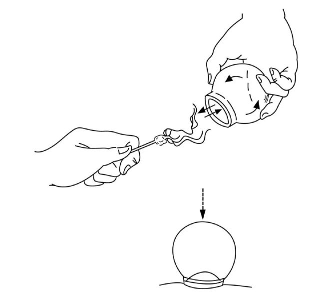 瘢痕的拔罐治疗